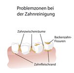 Problemzonen bei der Zahnreinigung